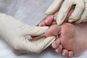 Causes of Diabetic Foot Pain