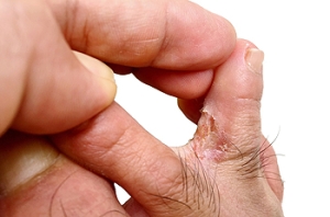 Athlete&#039;s Foot and Its Potential to Spread
