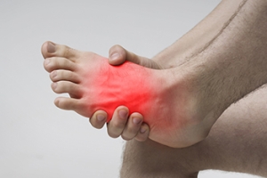A Lisfranc Injury