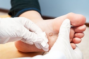 Painful, Persistent Plantar Warts
