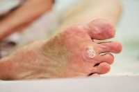 How Are Foot Warts Removed?