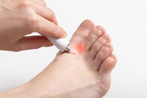 The Spreading of Athlete’s Foot